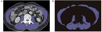 The Prognostic Value of Sarcopenia and Myosteatosis in Biliary Tract Cancer After Palliative Treatment With Radiation-Emitting Metallic Stent